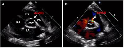 Transfemoral Occlusion of Doubly Committed Subarterial Ventricular Septal Defect Using the Amplatzer Duct Occluder-II in Children